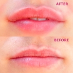 Pressensa Rose Lips  - гіалуронова ампула для губ під дермапен, 1x2 ml